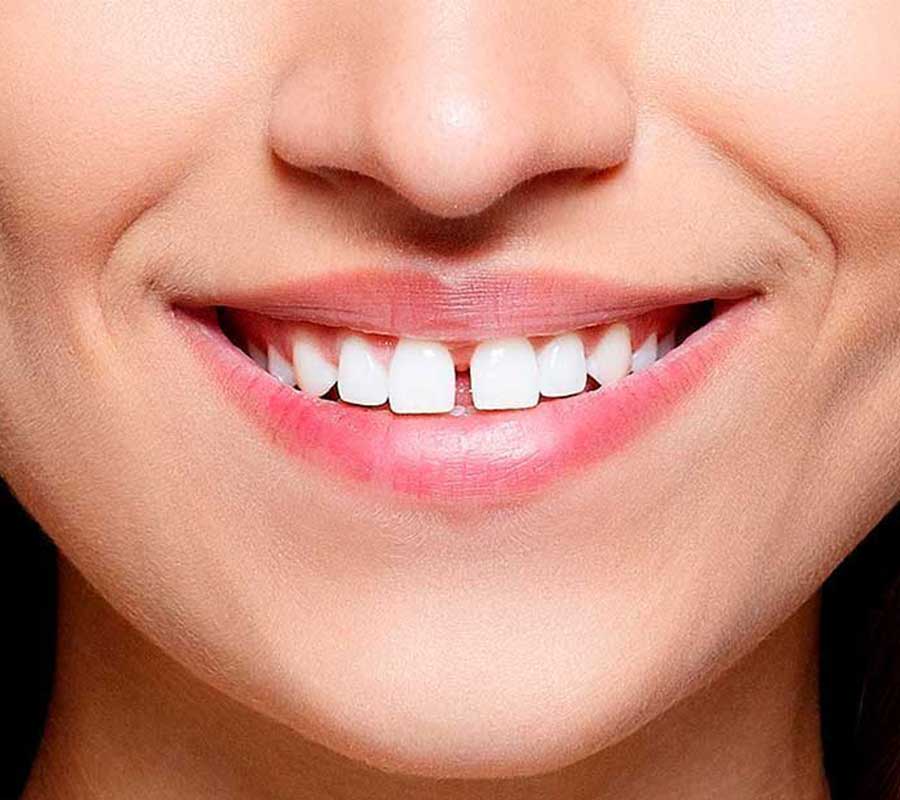 Diastema (Gap Between Teeth) treatment at Elite Clinic: Best Dentist in Rohini, Delhi