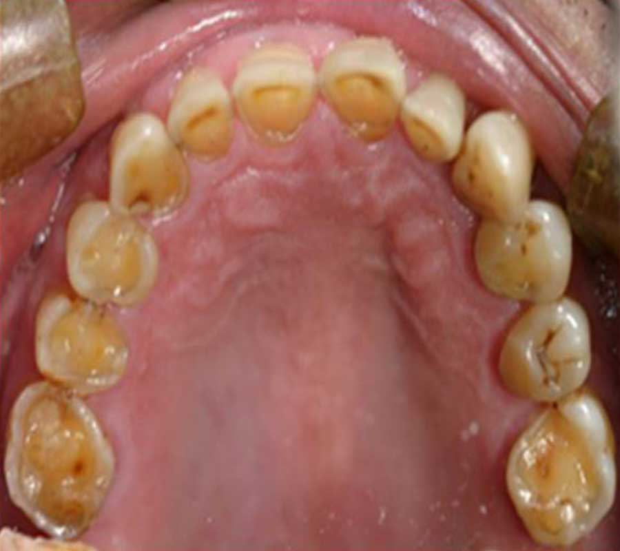Tooth Erosion at Elite Clinic: Best Dentist in Rohini, Delhi