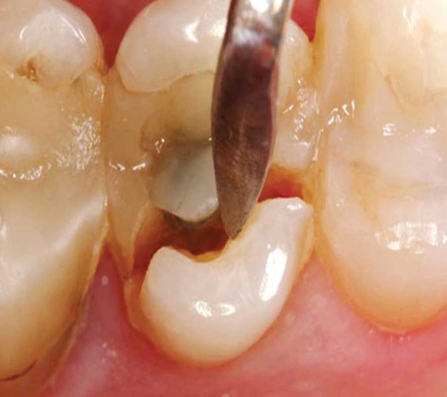 Tooth Fractures treatment at Elite Clinic: Best Dentist in Rohini, Delhi