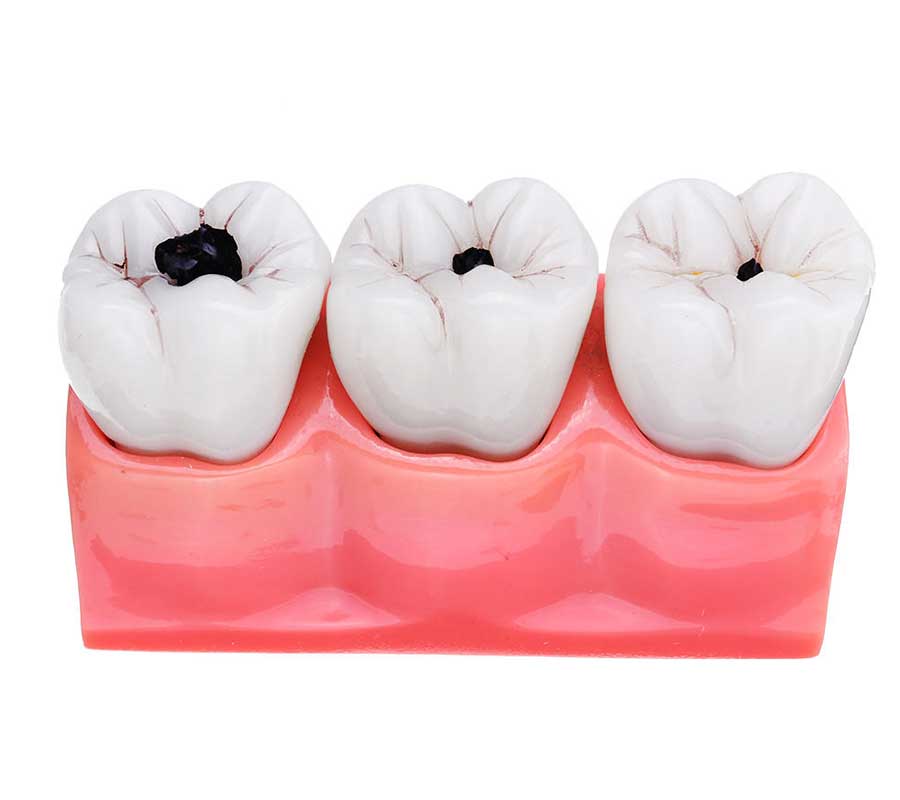 Tooth Decay (Dental Cavities) treatment at Elite Clinic: Dentist Clinic in Rohini, Delhi
