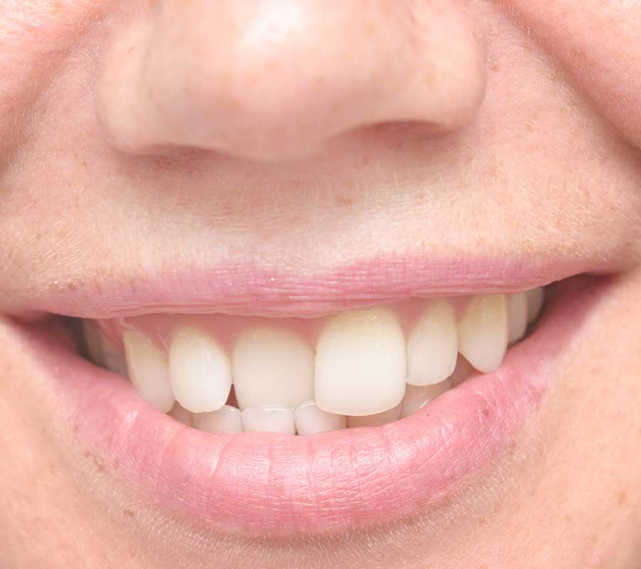 Crooked Teeth treatment at Elite Clinic: dental clinic in rohini | dental clinic in delhi