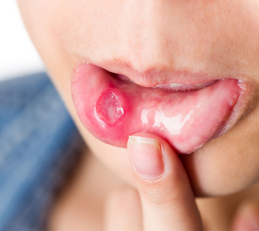 Oral Ulcers treatment at Elite Clinic: dentist in rohini | dentist in delhi