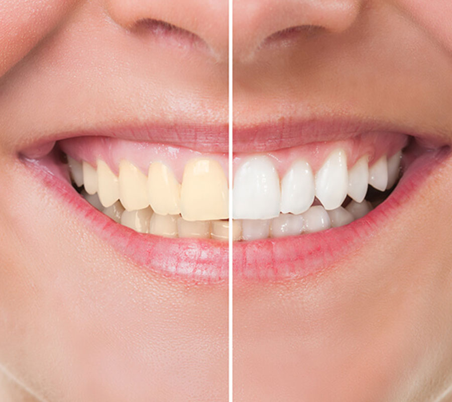 Stained Teeth treatment at Elite Clinic: dentist clinic in delhi ,rohini