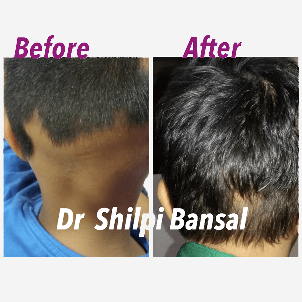 Before & After Alopecia areata medical treatment at Elite Clinic