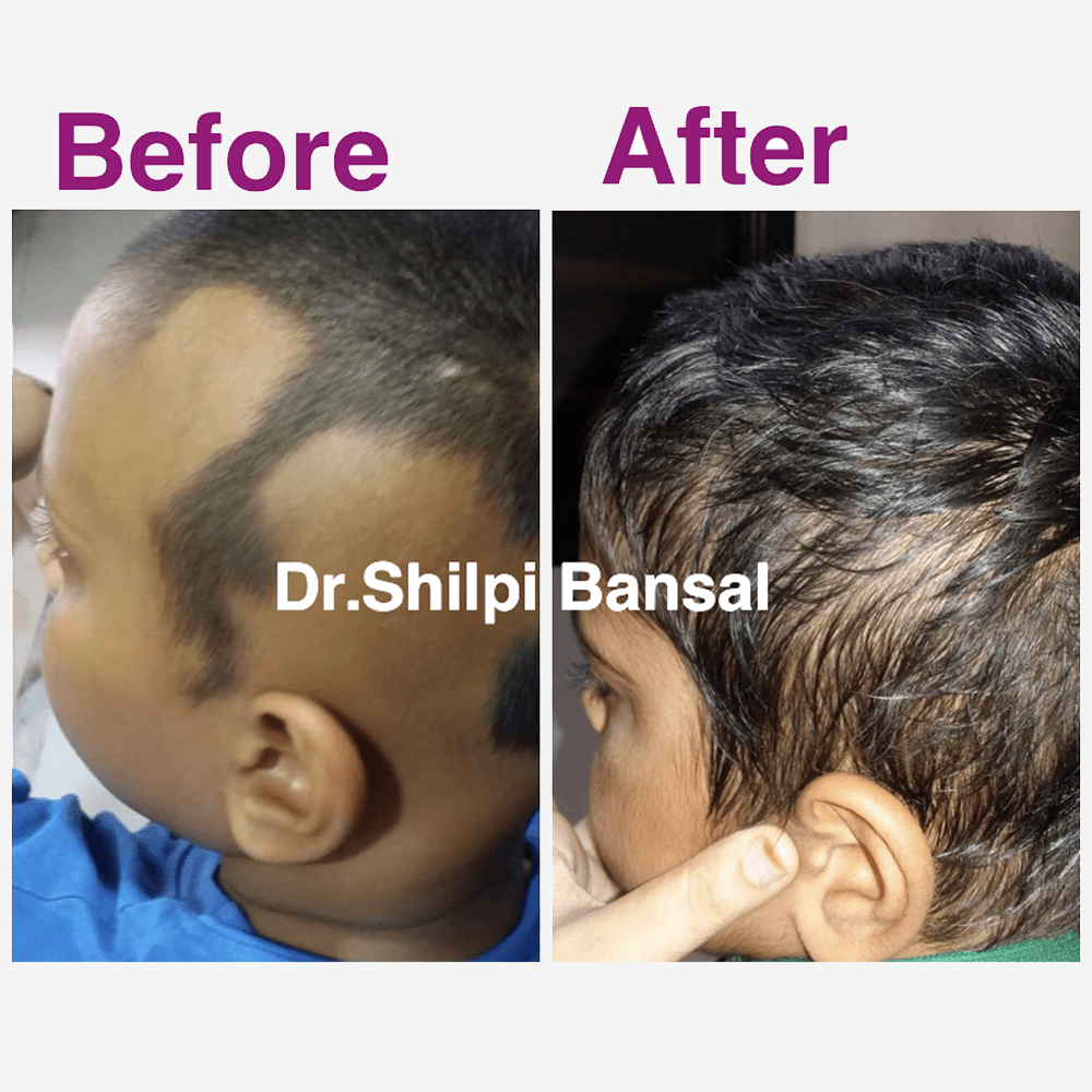 Before & After photos of Alopecia areata medical treatment
