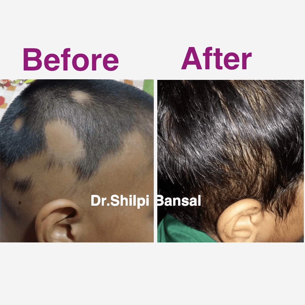 Before & After Alopecia areata medical treatment