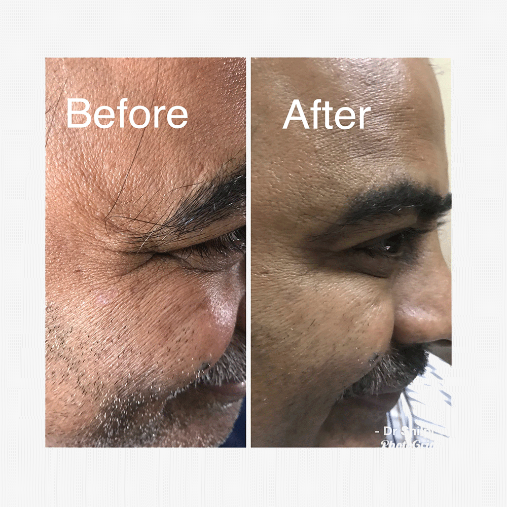Before & After Crow's feet treatment by Botulinum Toxin