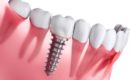 Dental Implants! Why is it the new trend