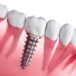Dental Implants! Why is it the new trend