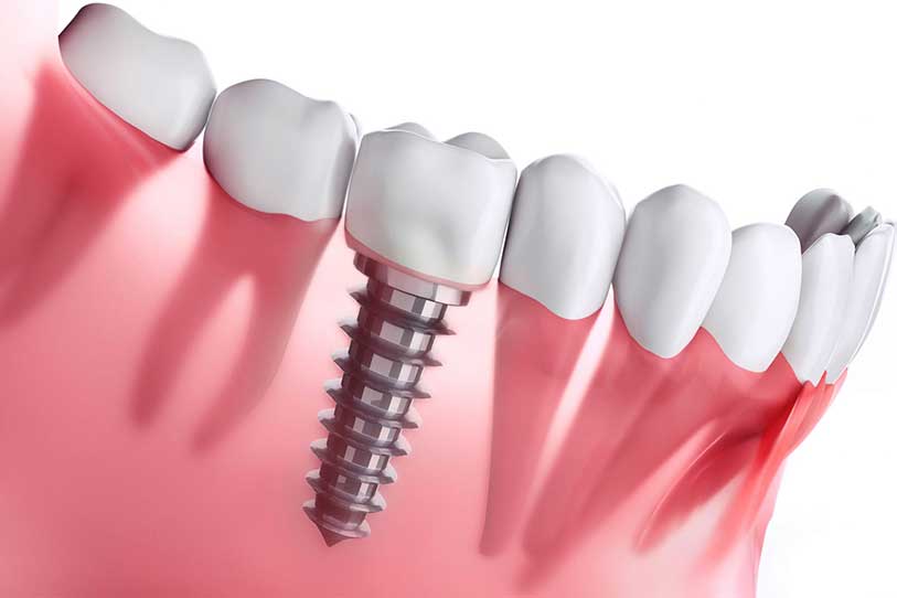 Dental Implants! Why is it the new trend