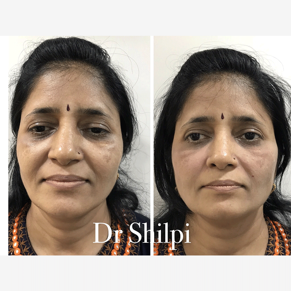 Before & After photos of Fillers treatment at Elite Clinic