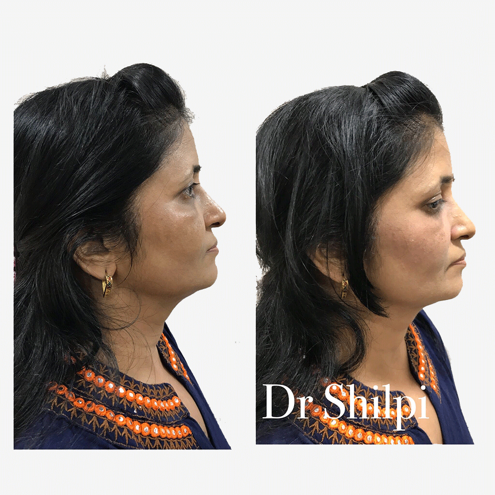 Before & After Fillers treatment at Elite Clinic