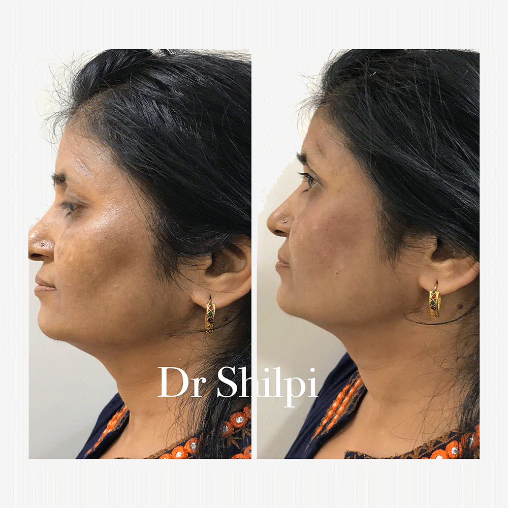 Before & After Fillers treatment