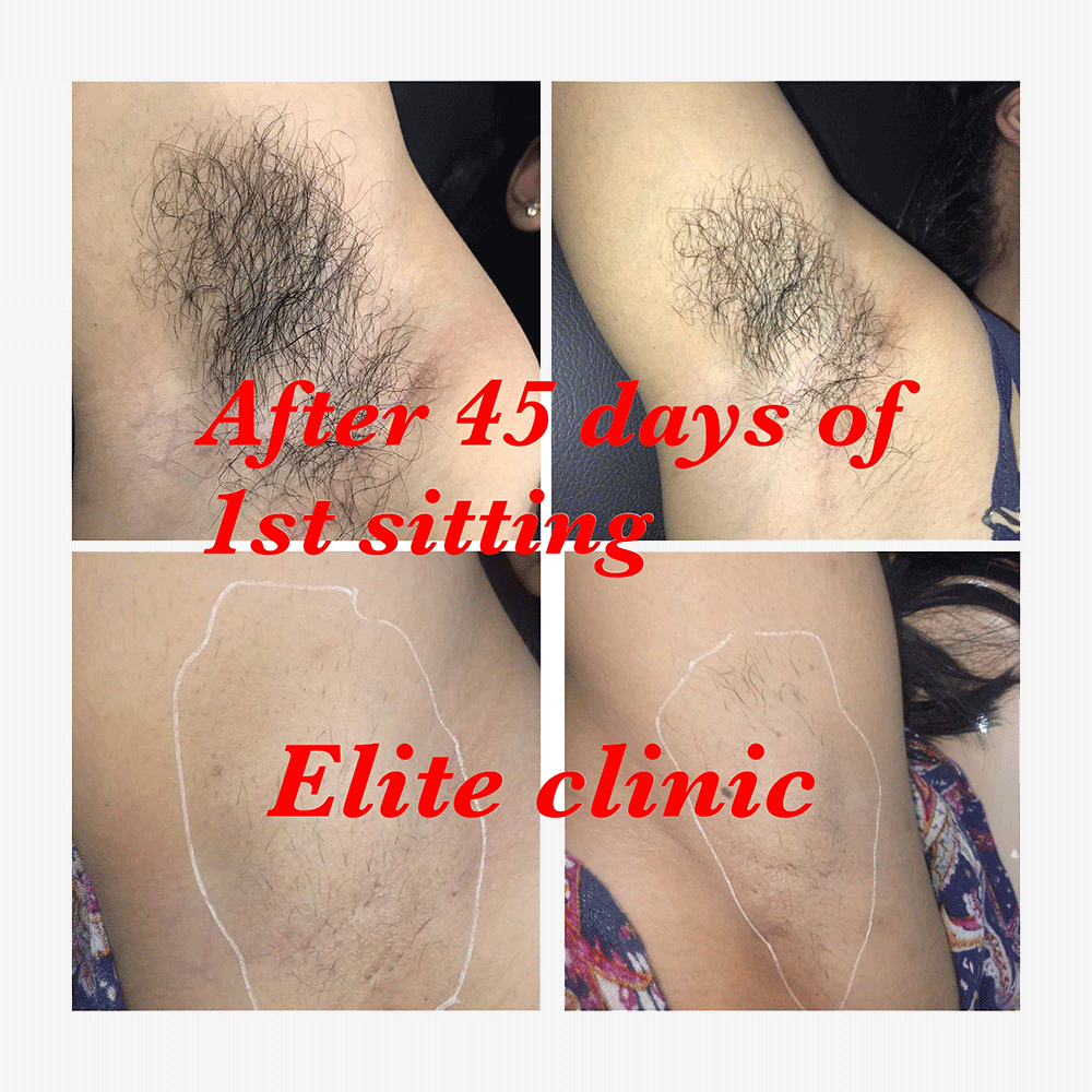 Before & After Laser hair reduction Treatment at Elite Clinic
