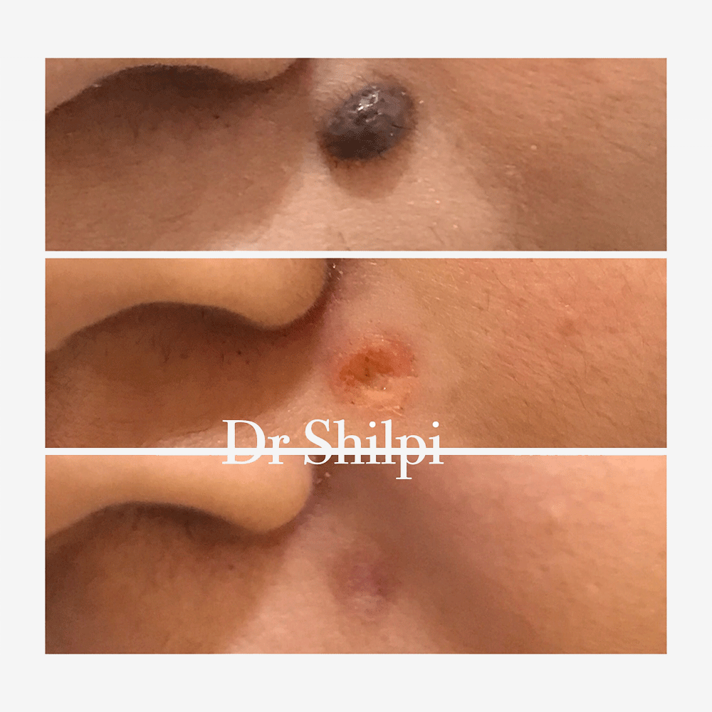 Before & After Mole removal by RF ablation at Elite Clinic
