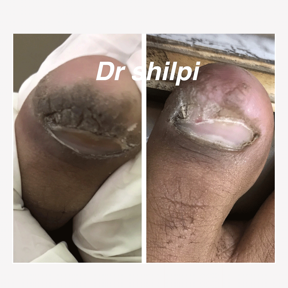 Before & After Non surgical Wart removal at Elite Clinic