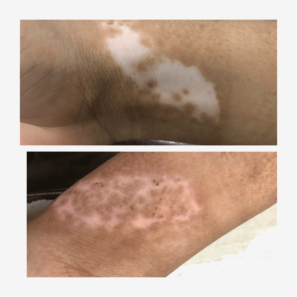Before & After photos of Vitiligo Treatment by surgery at Elite Clinic