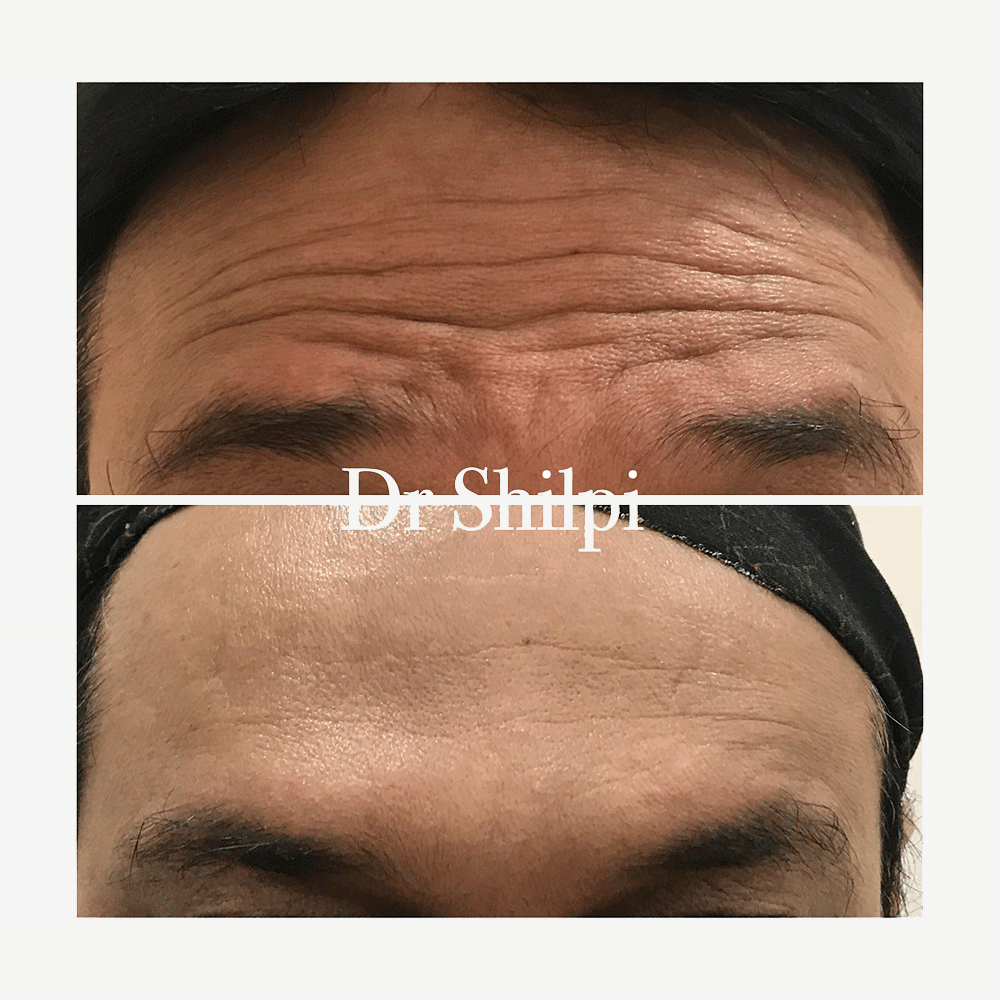 Before & After photos of Wrinkles treatment by Botulinum Toxin