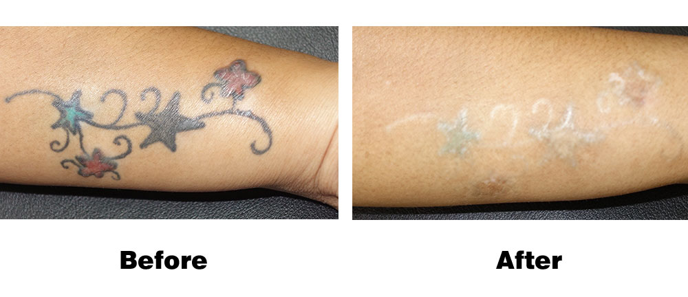 Elite Laser Tattoo Removal - Elite Clinic