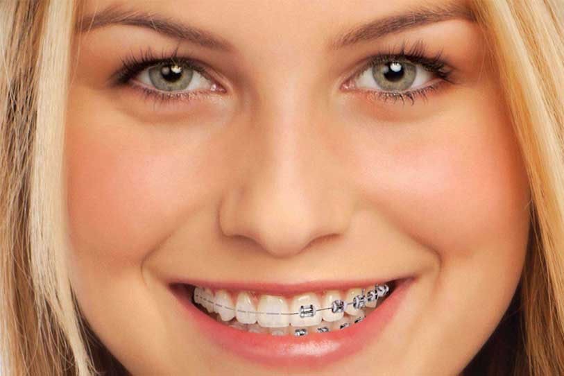 Orthodontics- Bracing for Braces - Elite Clinic